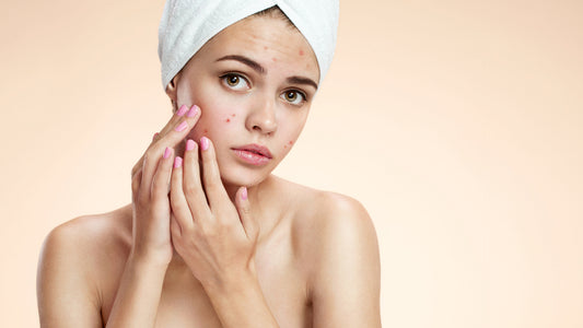 Winter Skin Care for Acne